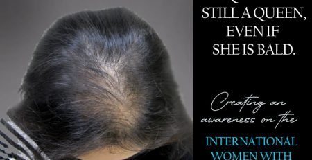 Woman with alopecia, showing thinning scalp, with text about International Women with Alopecia Month.