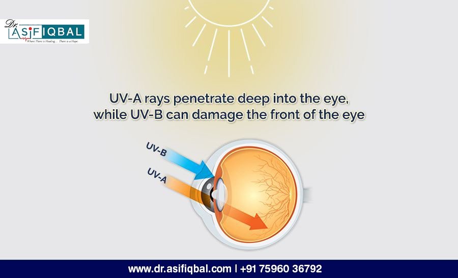 Illustration of UV rays affecting the eye